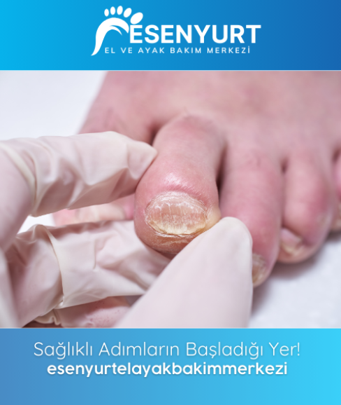 Mantarlı Tırnak Bakımı